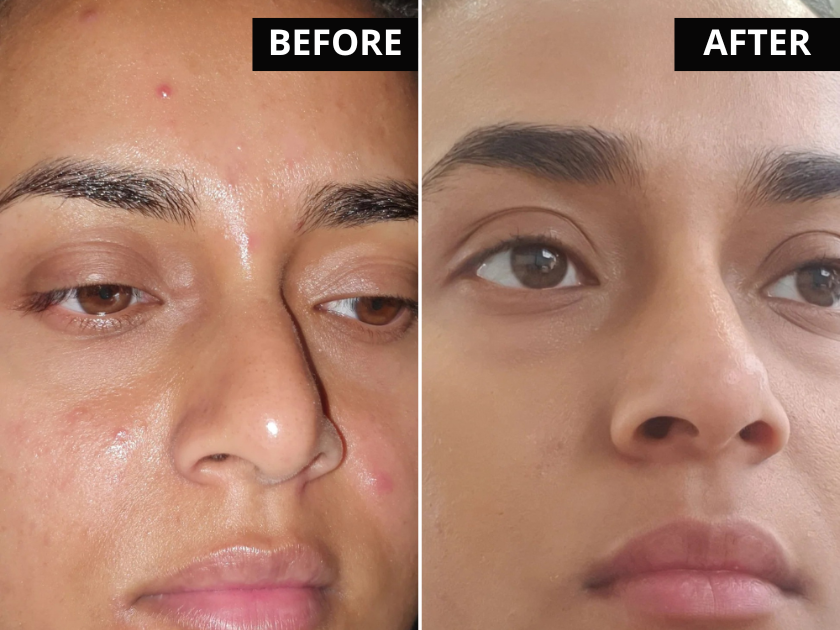 Comfortable, skin-friendly hydrocolloid tape in use